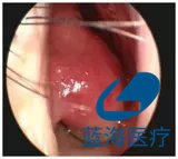 等離子消融術